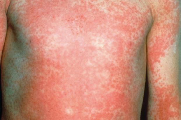 Scarlet Fever in Children - Kids Home Page