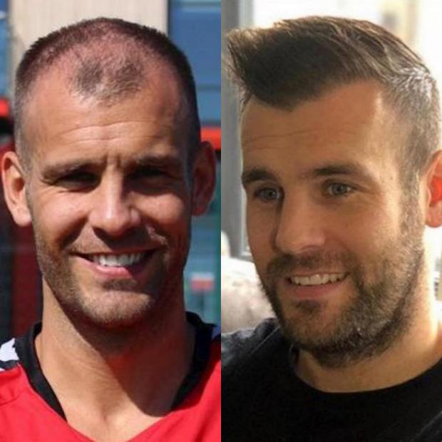 The Bolton News: Tommy Spurr before and after a hair transplant