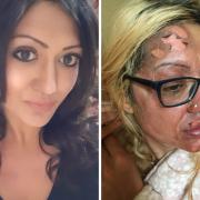 Shafia Bashir, who suffered burns after trying a TikTok egg hack